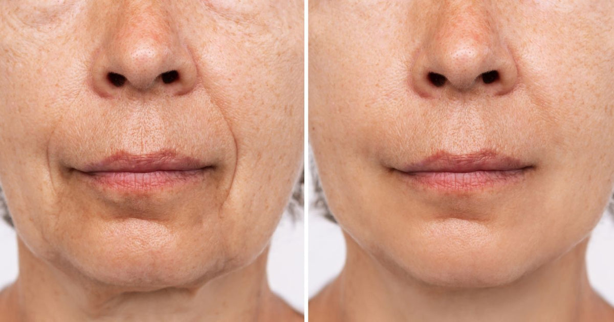 MYOLUNA Lift Pro — Appareil de soin du visage